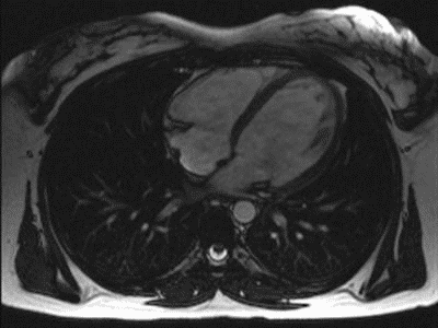 Schlagendes Herz, Vierkammerblick (MRT-Schichtbild)-Cardiac_mri_ani1_bionerd_Quelle/Wikipedia_Ersteller: Bionerd